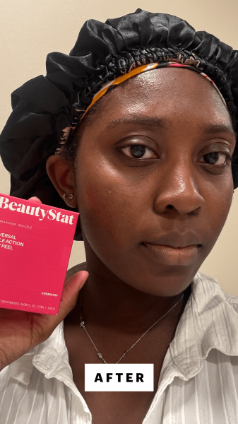 BlayTettey after using the BeautyStat Universal Triple Action Daily Peel
